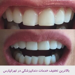 بالاترین تخفیف خدمات دندانپزشکی در تهرانپارس