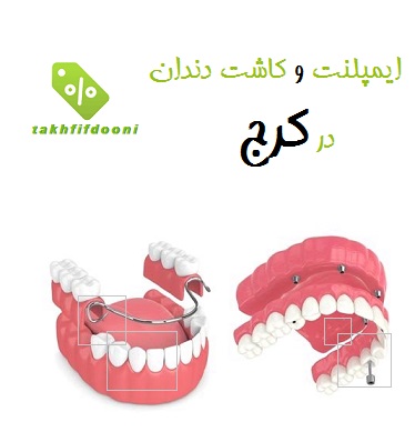ایمپلنت و کاشت دندان در کرج